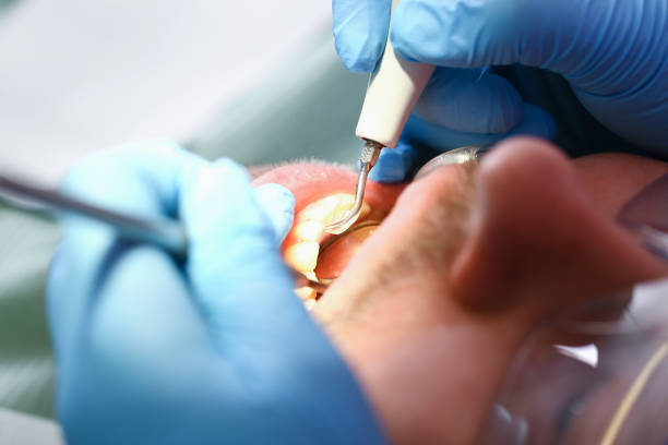 Best Emergency Treatment for Dental Infections or Abscesses in Bonita Springs, FL