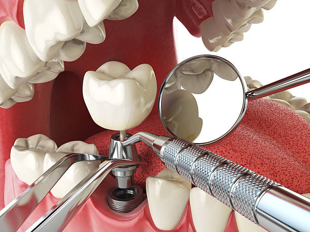 Best Emergency Wisdom Teeth Removal in Bonita Springs, FL